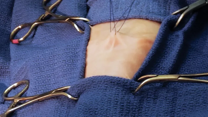 A draped surgical field with two placed sutures being pulled upwards.