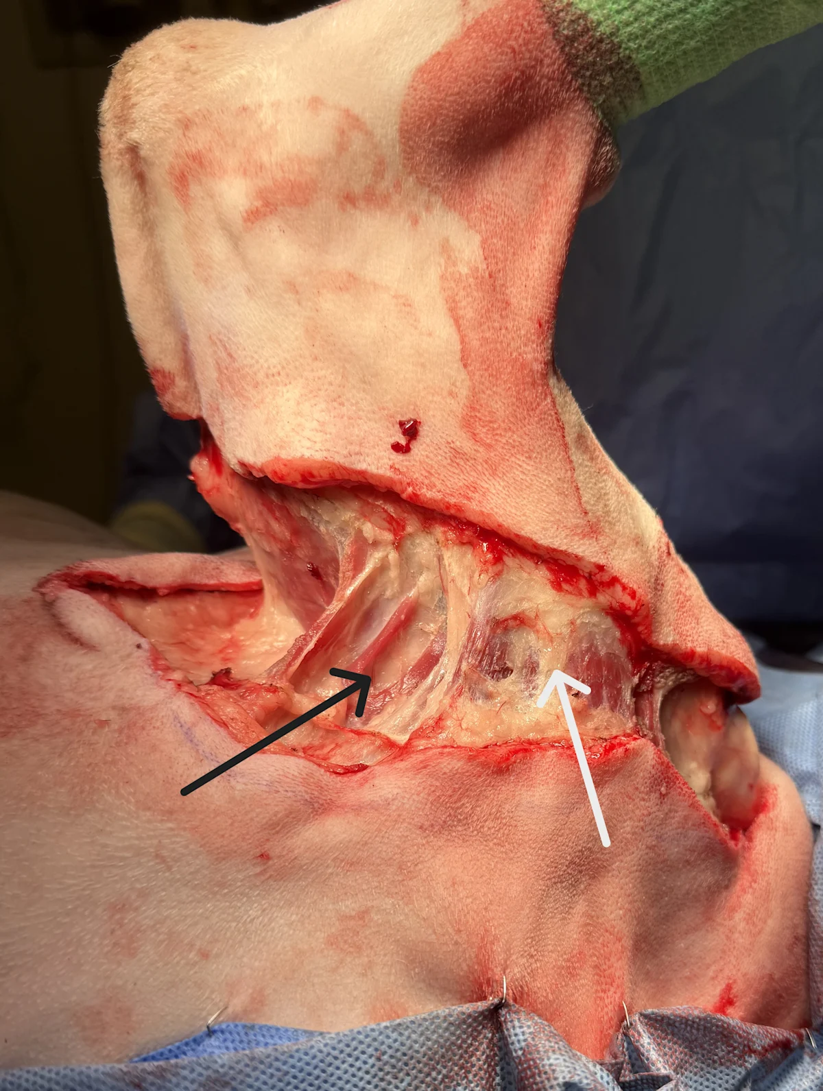 Pectoral muscles of a dog during surgery for amputation.