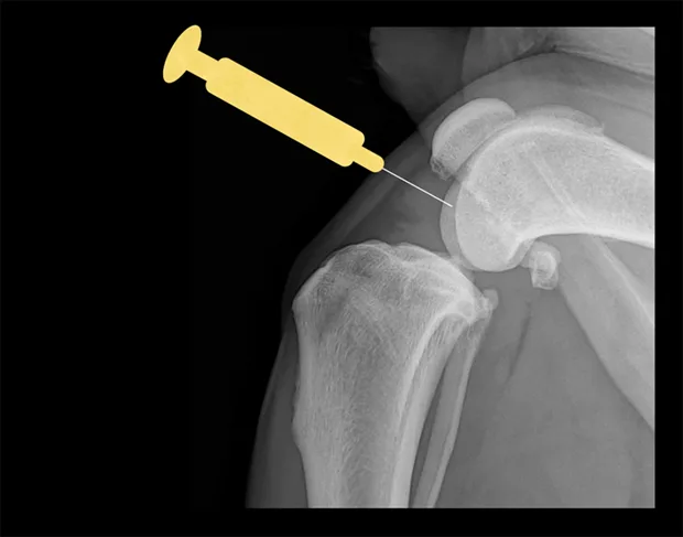 Lateral radiograph of a flexed canine stifle with a needle inserted into the joint space.