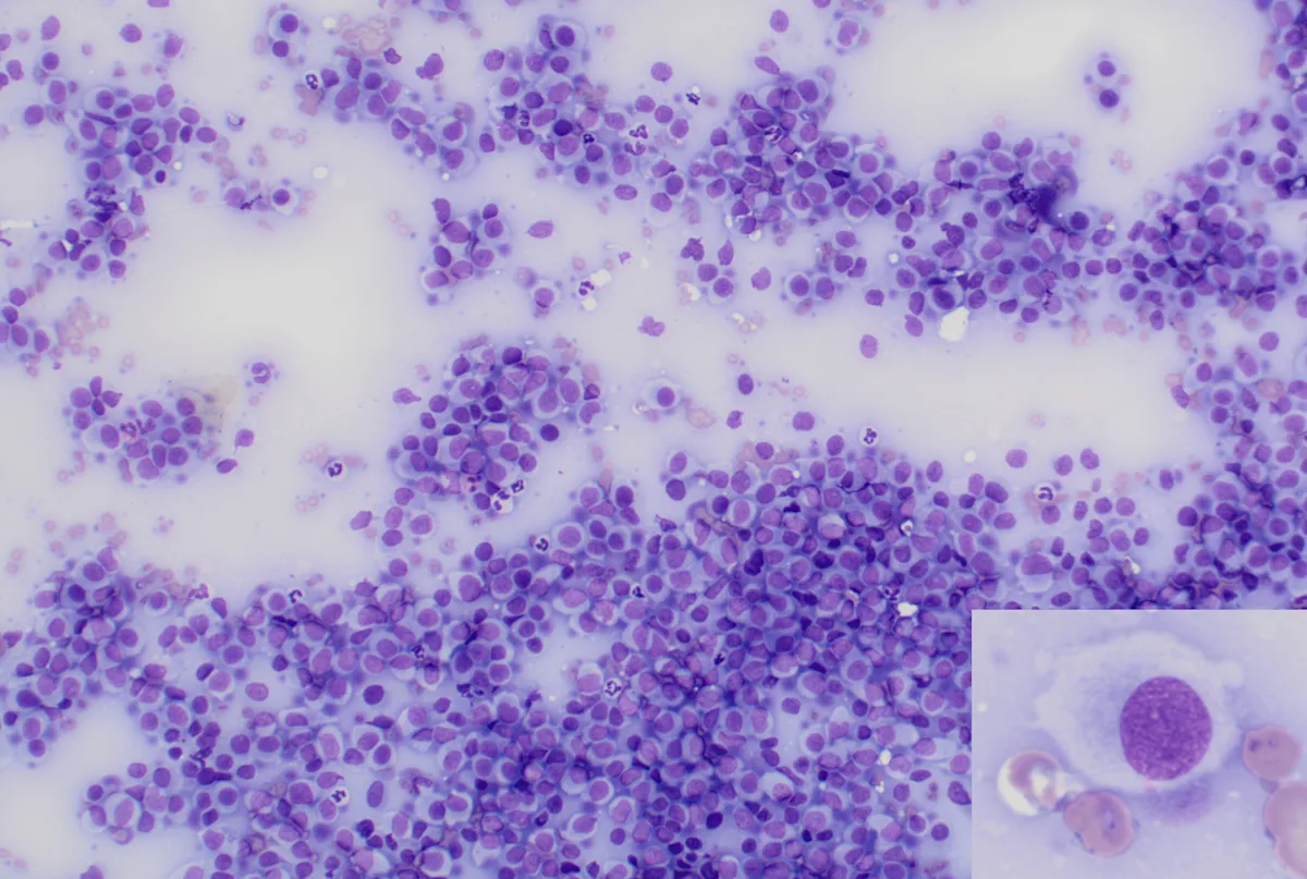 Numerous individual round cells with light-bluish cytoplasm and round, purple staining nuclei.