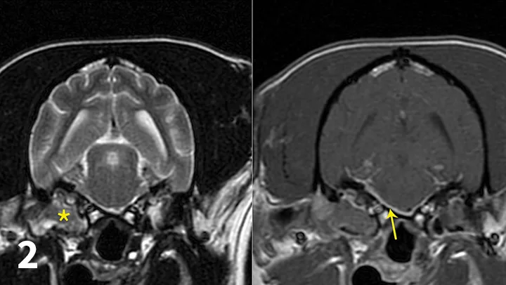 Contrast and post-contrast MRI images with markings denoting lesions in right middle ear extending into calvarium.