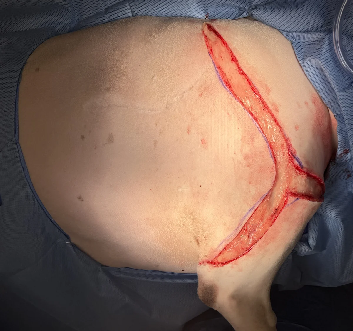 Lateral view of draped shaved right forelimb and thorax of dog with fresh upside down Y-shaped incision.