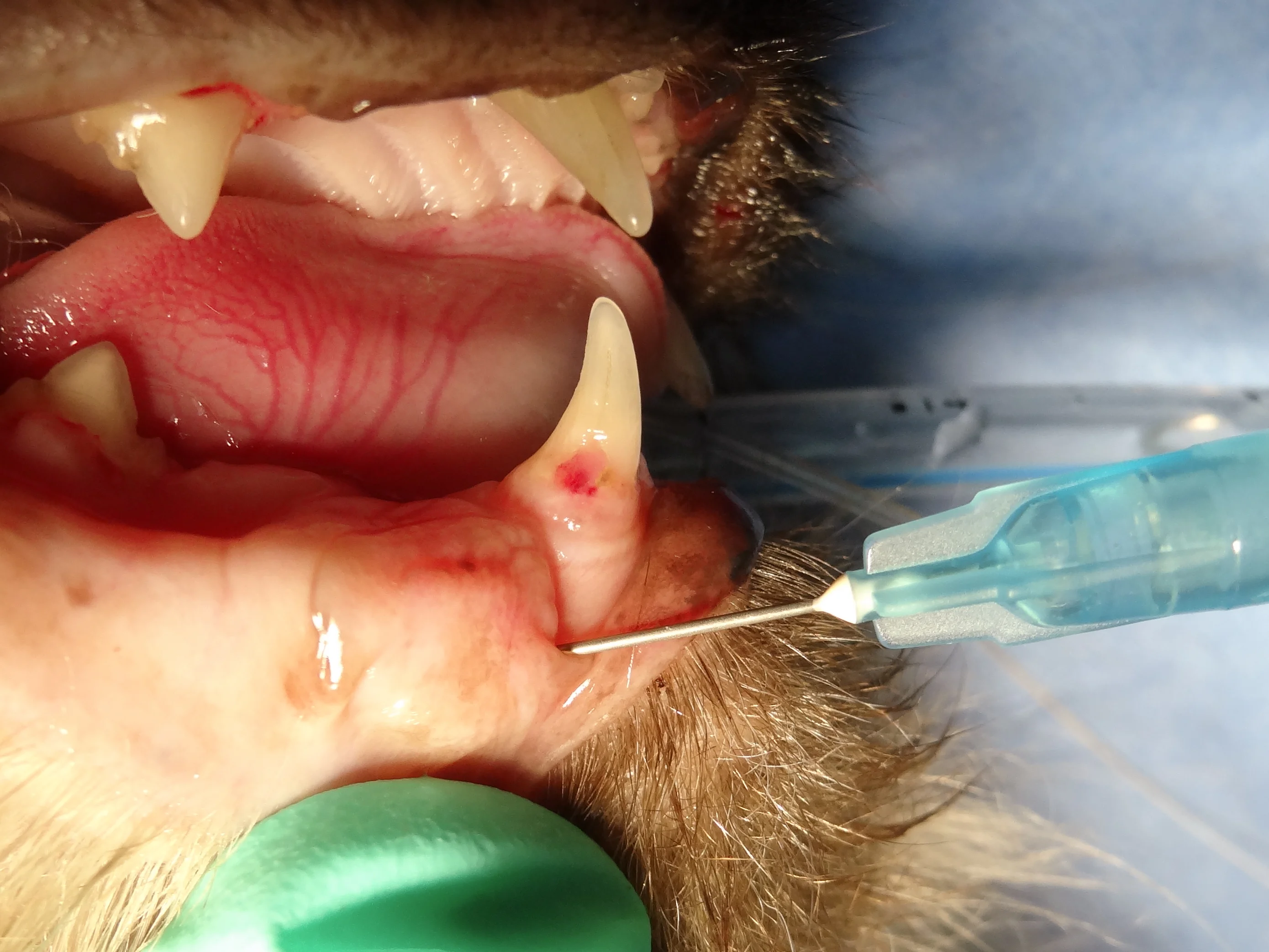 The placement of a needle into the middle mental foramen in a live patient.