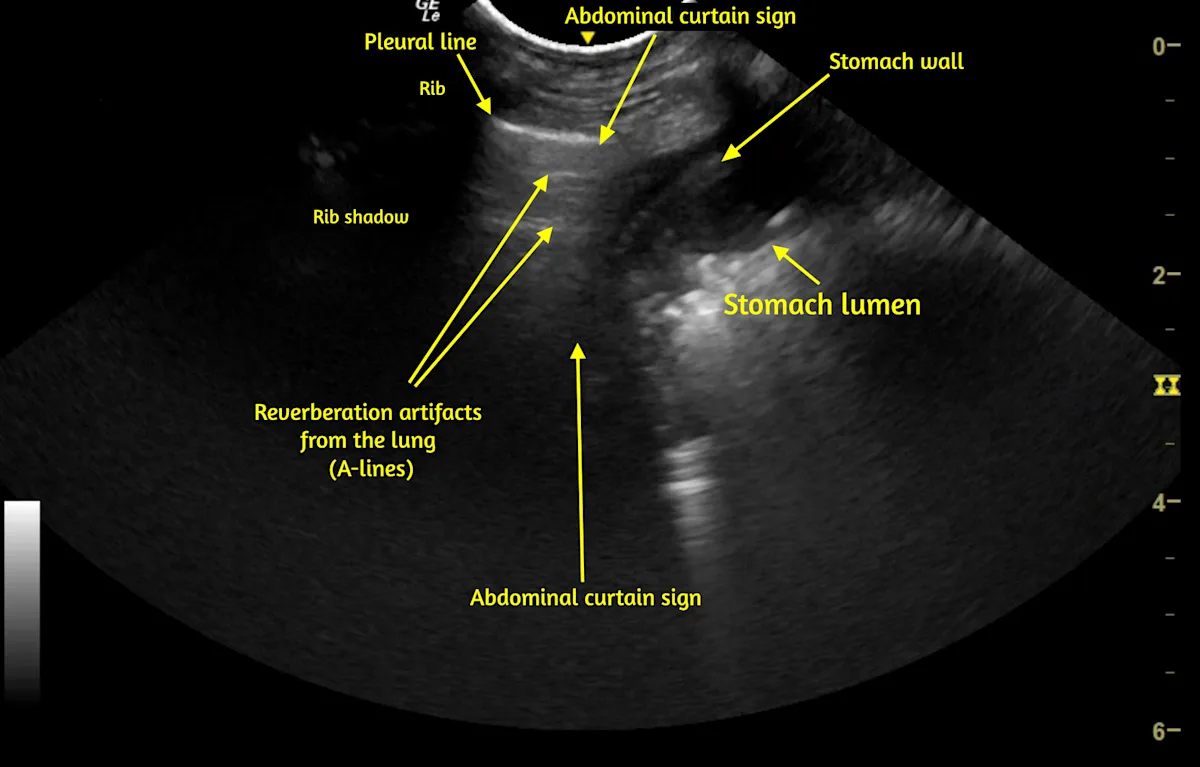 Still image of ultrasound video demonstrating abdominal curtain sign with relevant sections labeled for identification.