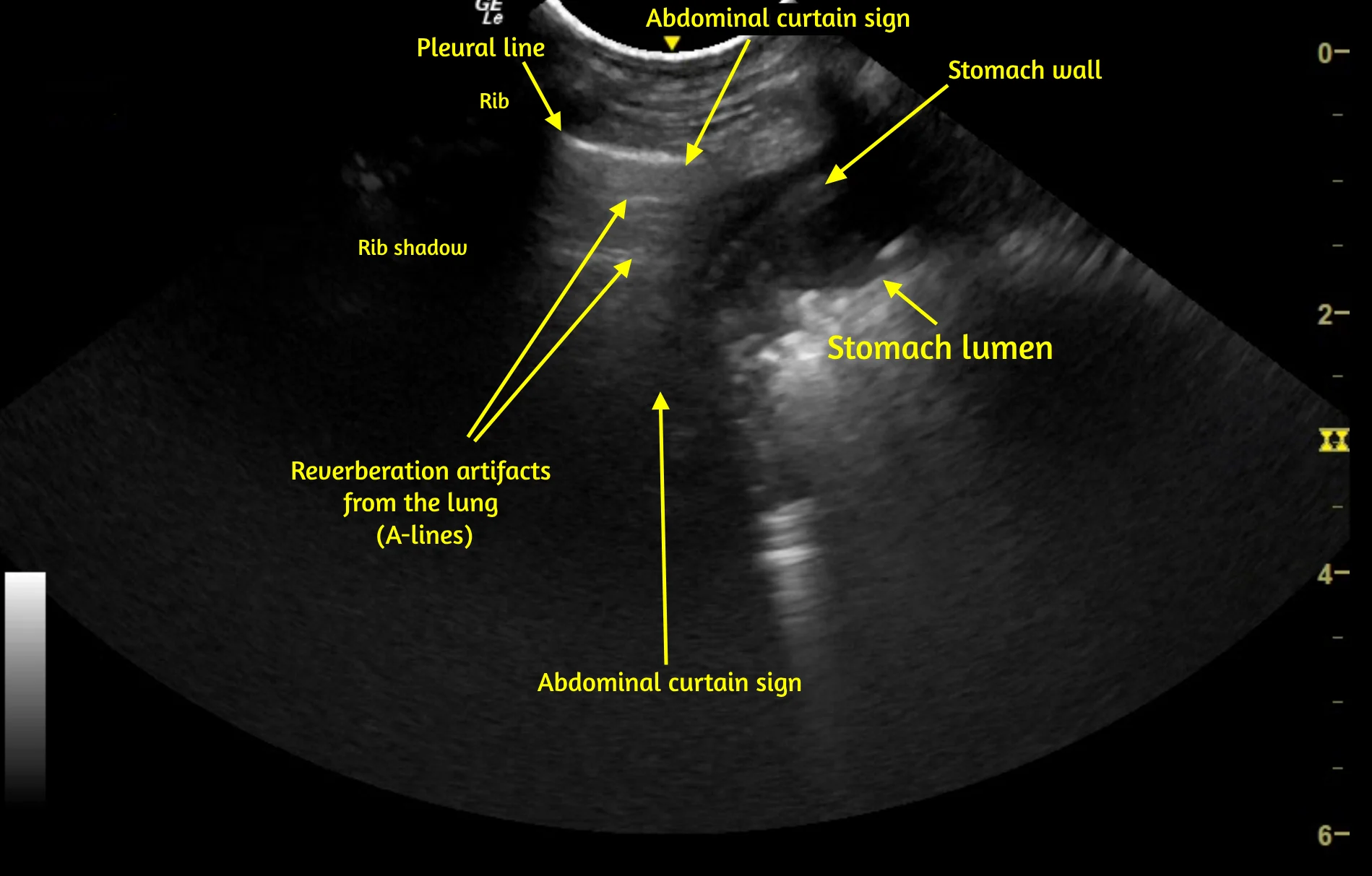 Still image of ultrasound video demonstrating abdominal curtain sign with relevant sections labeled for identification.