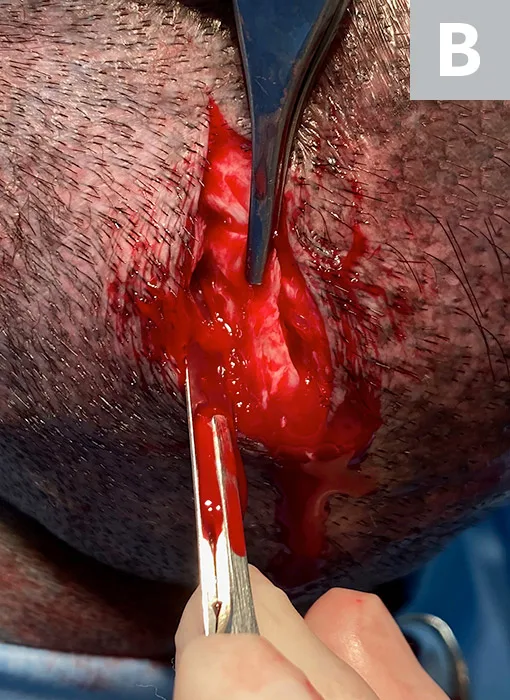 Two images showing how to incise through a tumor to collect a biopsy specimen.