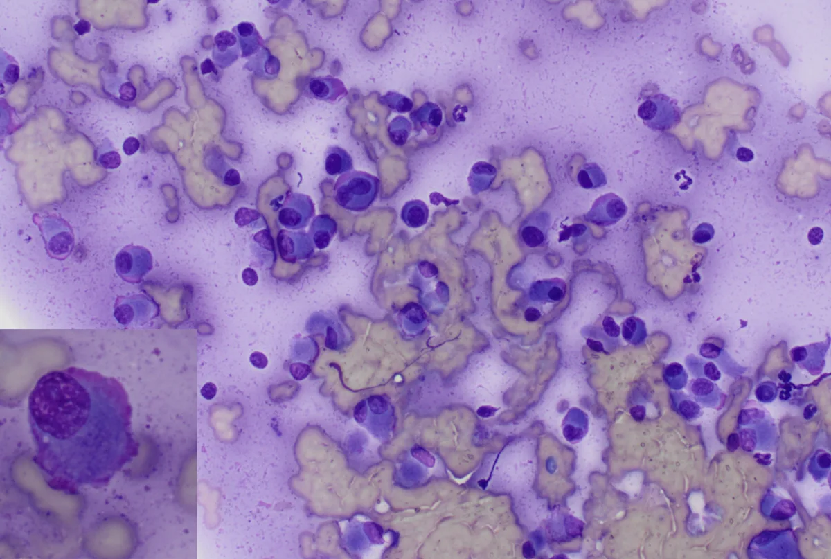 Numerous single, round purple cells with eccentric dark-purple nuclei and a magnified cell with pink edging around the border.