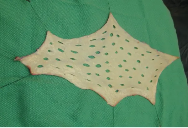 Meshed skin graft with all subcutaneous tissue removed.
