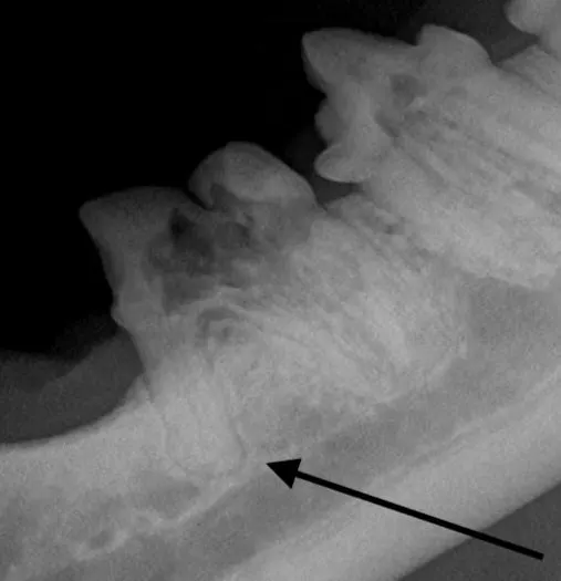 Four dental radiographs showing different root anomalies that can contribute to root fracture during extraction. 