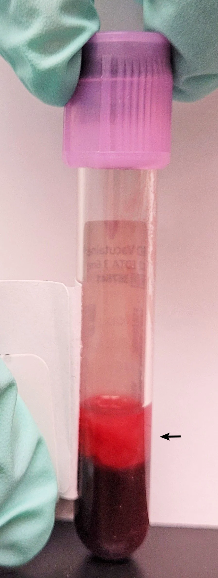 Gloved hands holding blood tube with arrow pointing to pink opaque fluid layer overlying RBC layer.