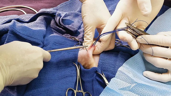 A draped surgical field with one set of gloved hands holding sutures up and away from the field while another set places another suture.