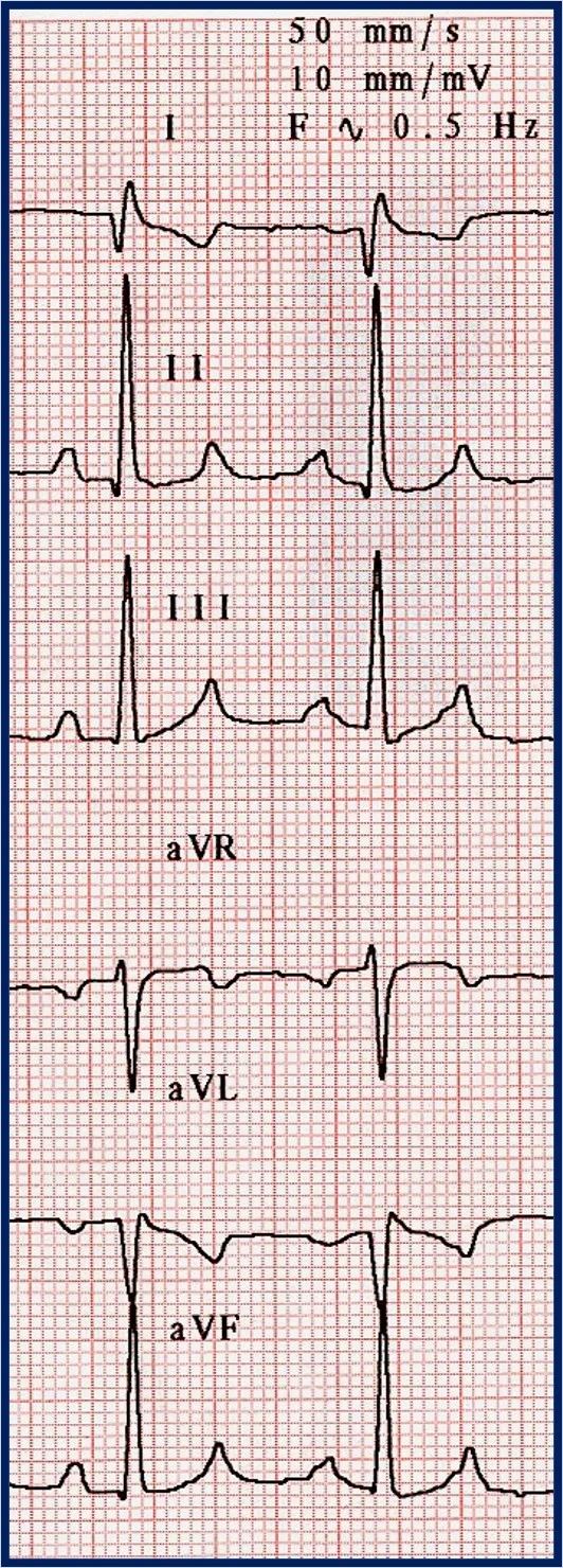 A 6-lead ECG printout showing 2 beats.