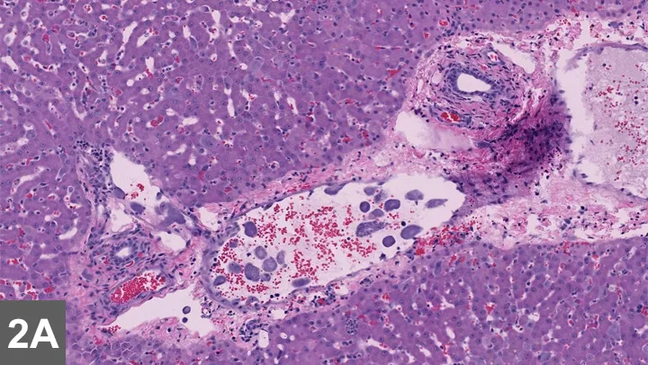 Histopathology slide showing a hepatic vein containing macrophages within the hepatic parenchyma.