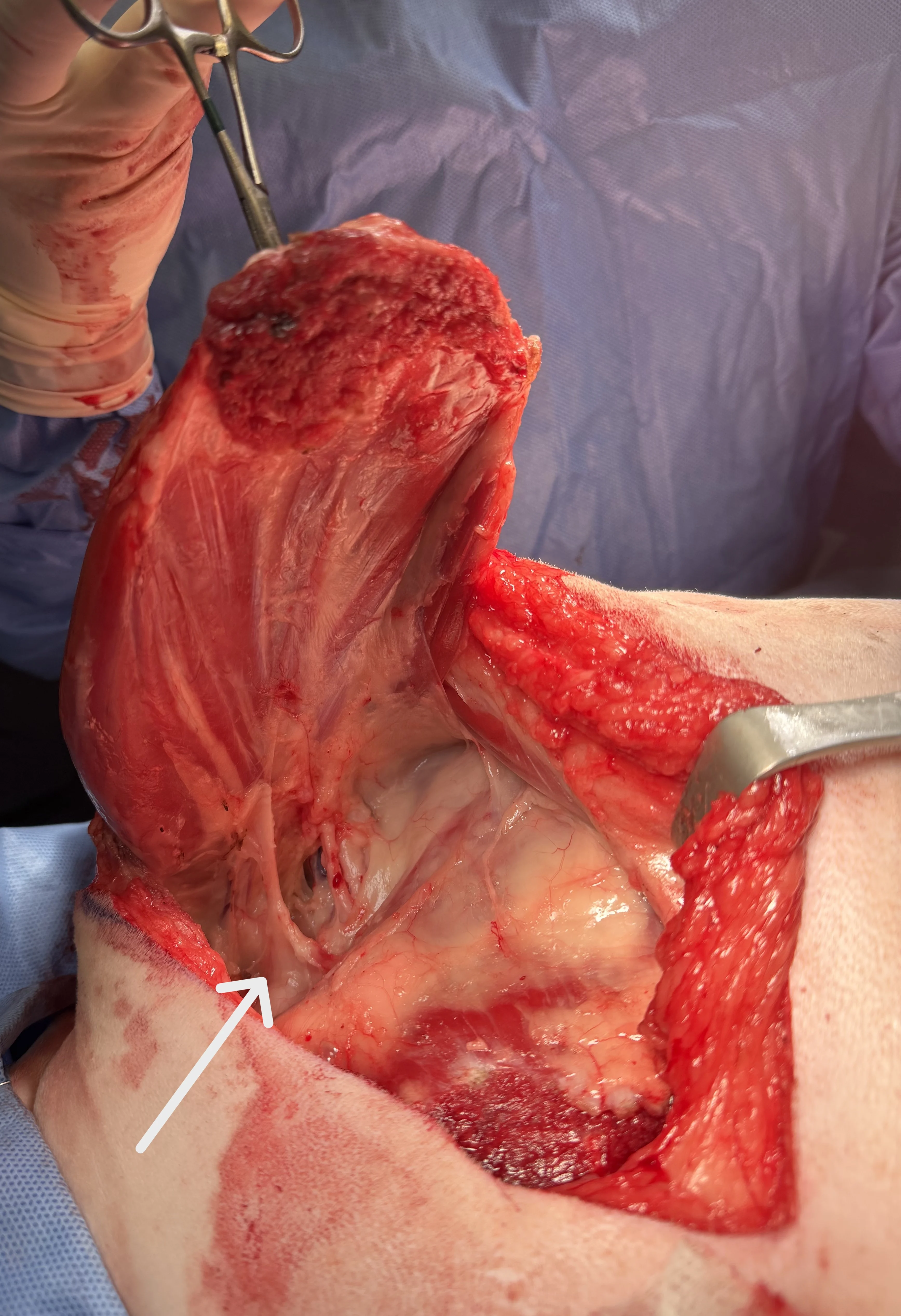 Detached scapula lifted upwards with arrow pointing to exposed brachial plexus.