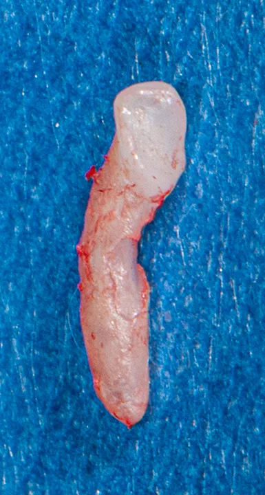 Extracted incisor tooth with caudal erosive lesion mid-root.