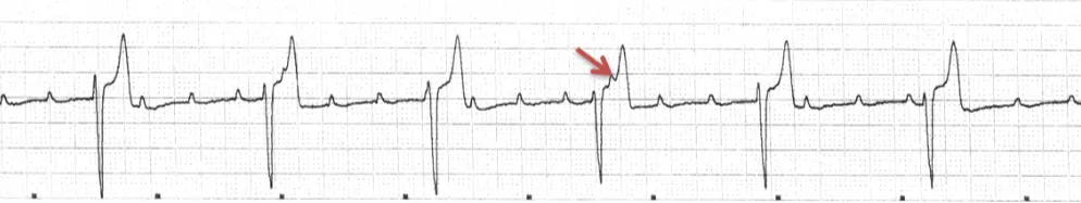 ECG tracing with wide, bizarre, negatively deflected QRS complexes representing a ventricular escape rhythm. A red arrow indicates a P wave visible within one T wave.