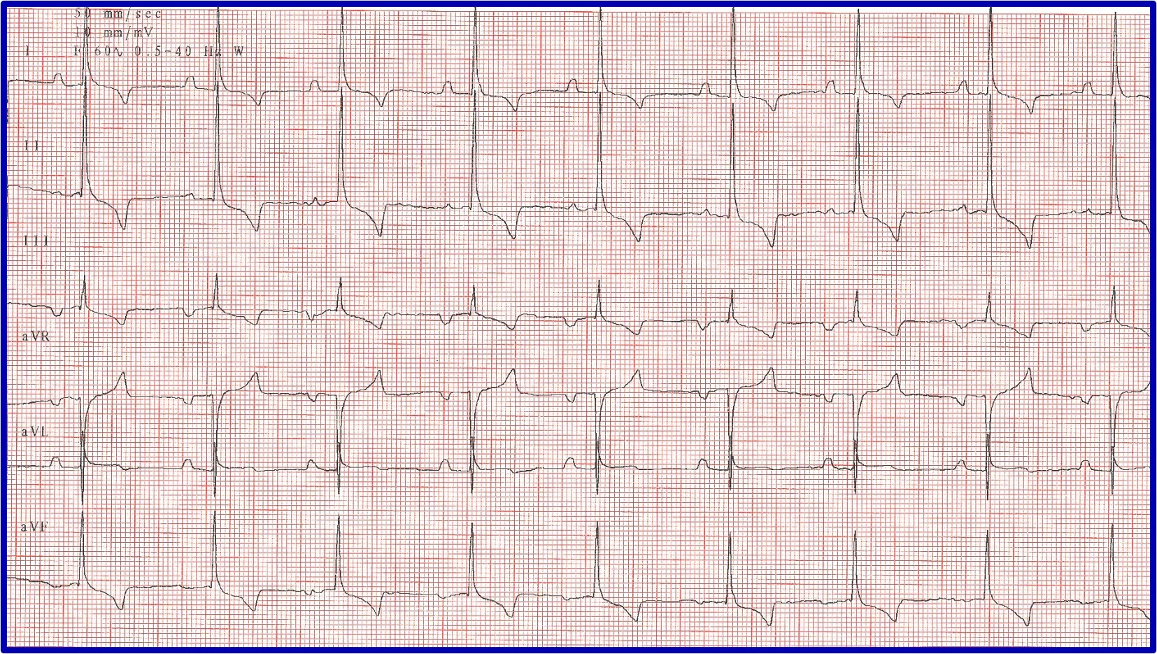 Figure 8A: A 6-lead ECG showing a long pause and delayed rescue beat. Figure 8B: A post-atropine ECG normal beats but bradycardia.