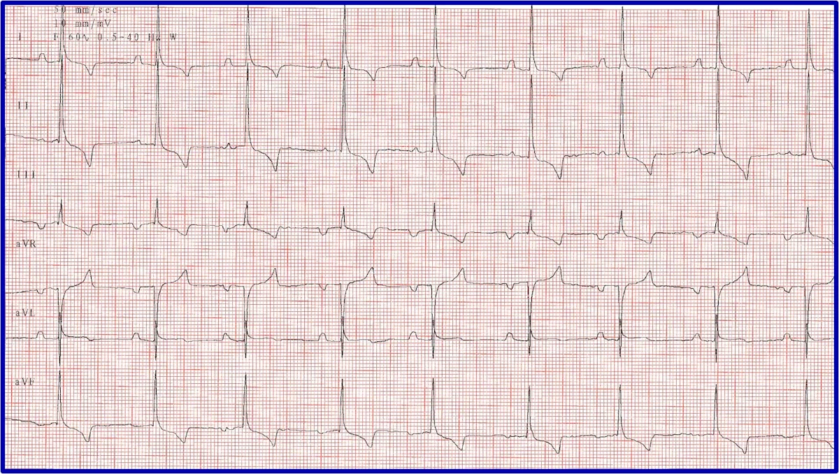 Figure 8A: A 6-lead ECG showing a long pause and delayed rescue beat. Figure 8B: A post-atropine ECG normal beats but bradycardia.