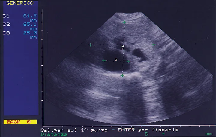 Ultrasound image of prostate with markers on screen delineating size of findings.