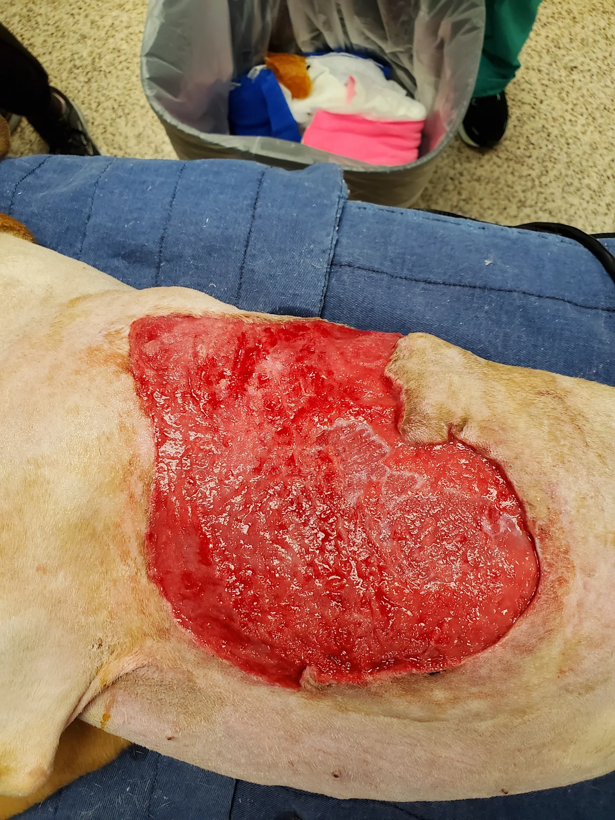 Left: A granulation bed is present on the wound surface. Right: Post-op photo after partial wound closure. 