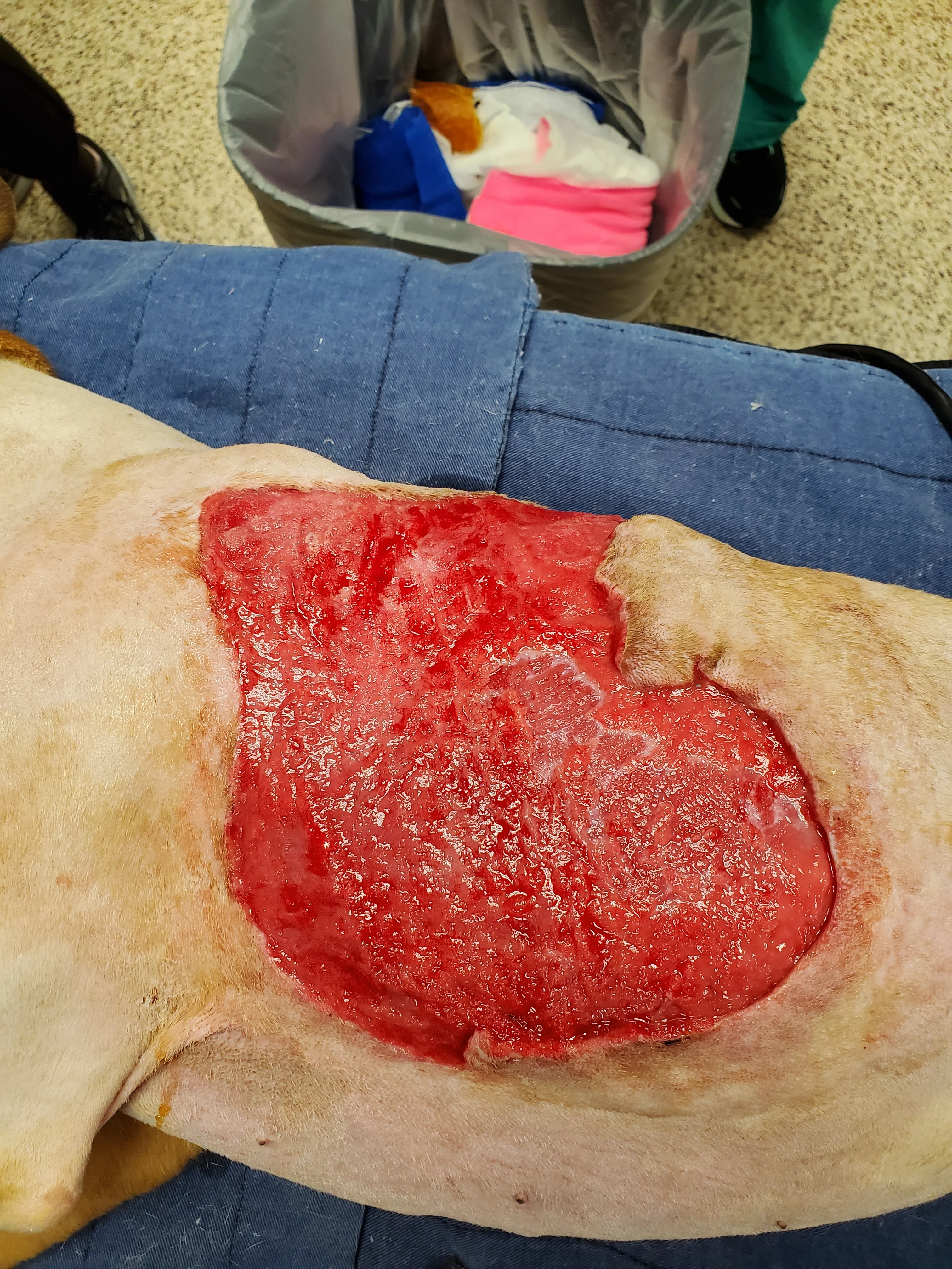 Left: A granulation bed is present on the wound surface. Right: Post-op photo after partial wound closure.