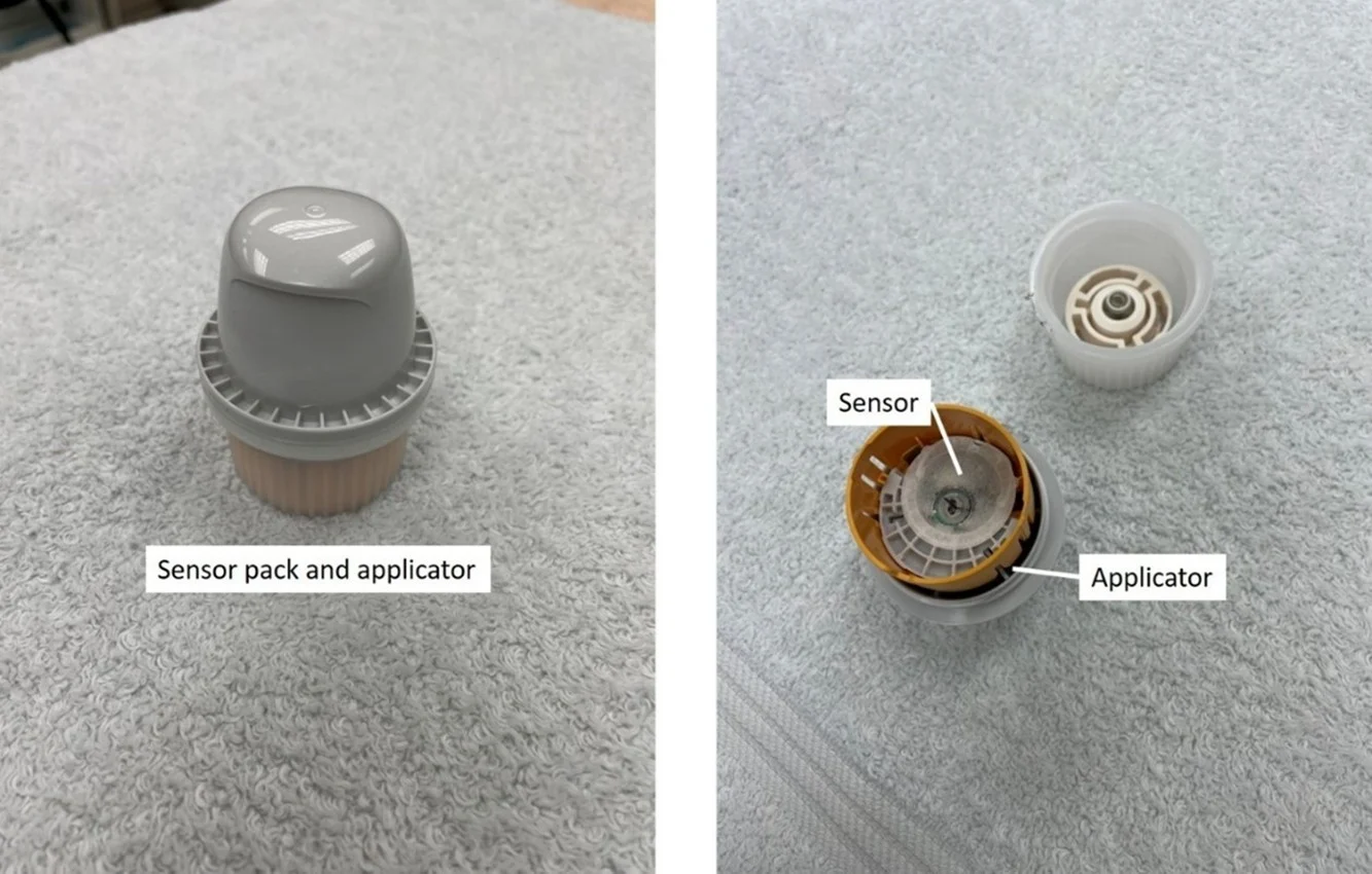 Assembled and disassembled views of labeled continuous blood glucose monitor.