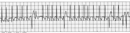 ECG tracing with two different QRS morphologies and an elevated heart rate. Most complexes are narrow and positively deflected and there are occasional wider, negatively deflected complexes. 