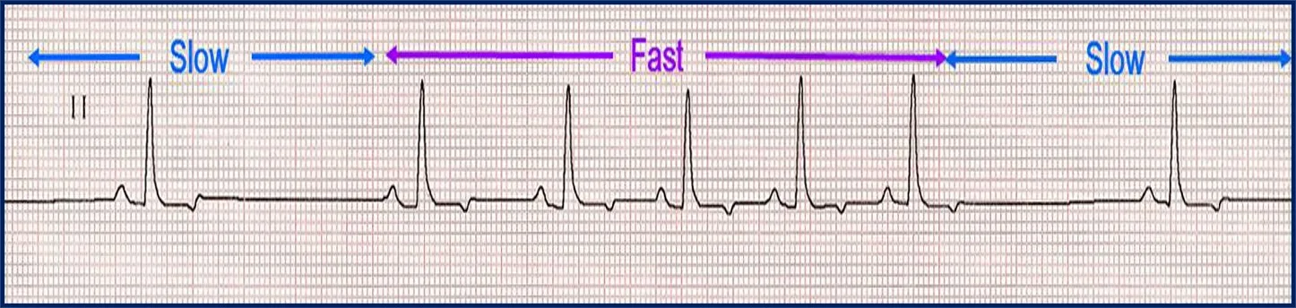 A lead II ECG printout showing alternating slow and fast beats.