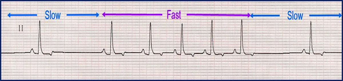 A lead II ECG printout showing alternating slow and fast beats.