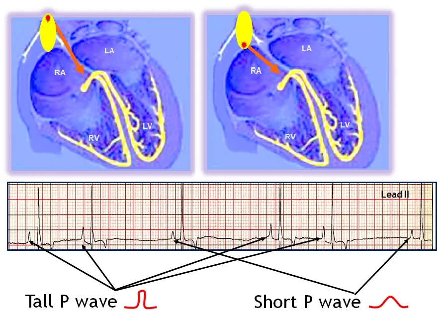 An illustration of the heart’s conduction system, and an ECG showing both tall and short P-waves.