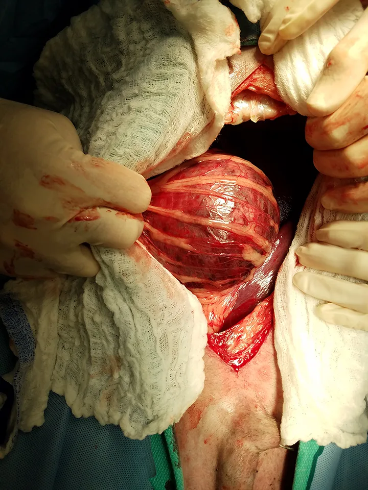 Intraoperative image of dark-red bloated stomach covered with layer of omentum.