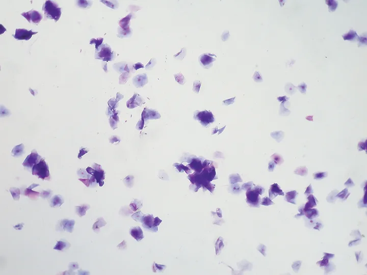 Cytology showing numerous angular cells with and without nuclei.
