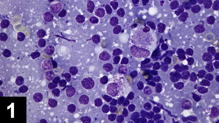 Stained cytology slide showing numerous dark purple lymphocytes and several larger macrophages.