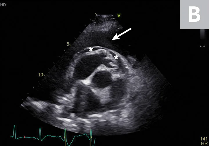 Two ultrasound images showing hypoechoic fluid adjacent to the spleen and to the heart.