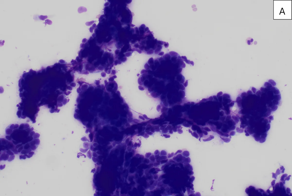 Multiple clusters of round-to-oval dark purple–staining cells.