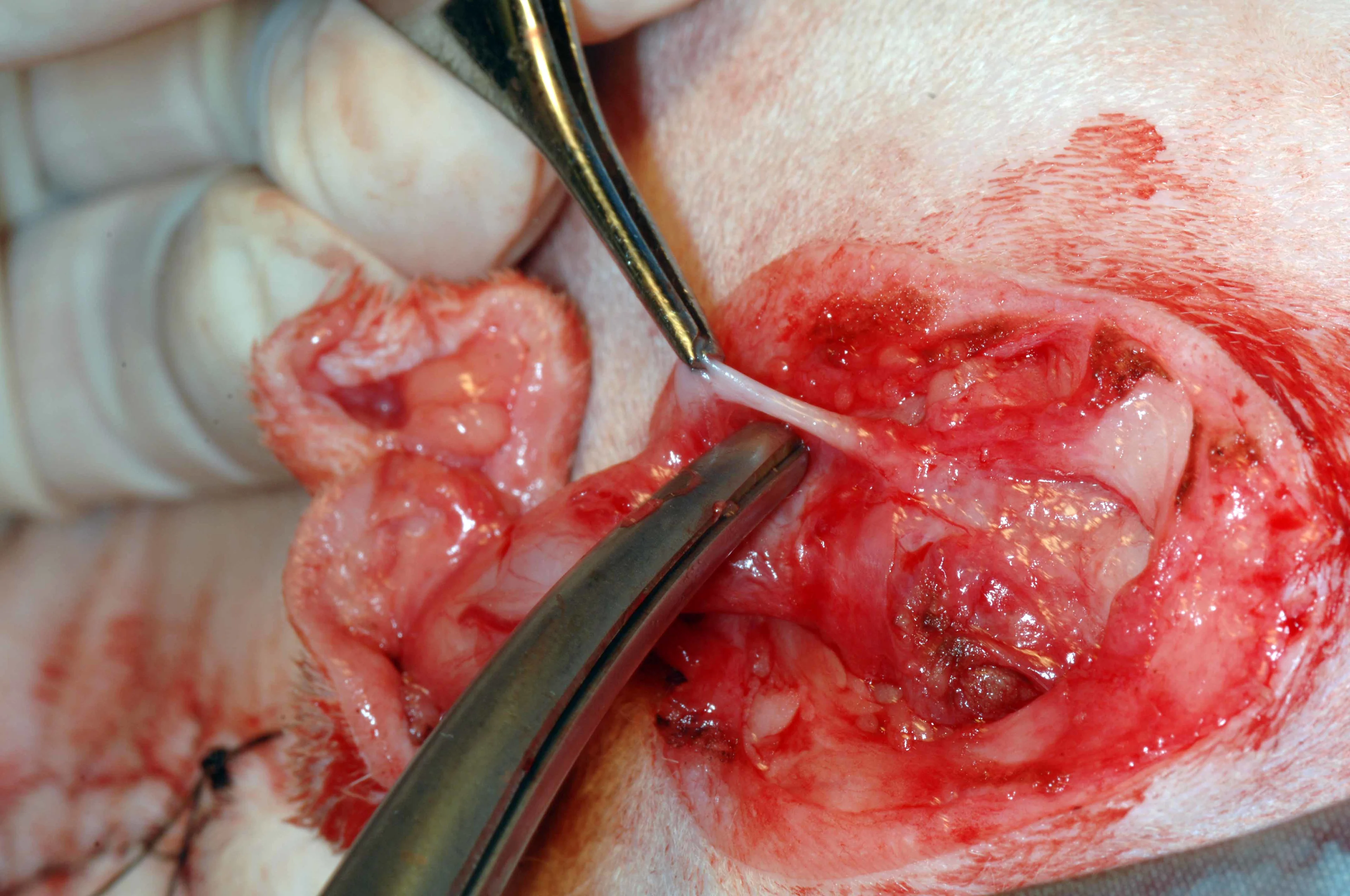 Intraoperative photo of a surgeon lifting the retractor penis muscle with forceps.