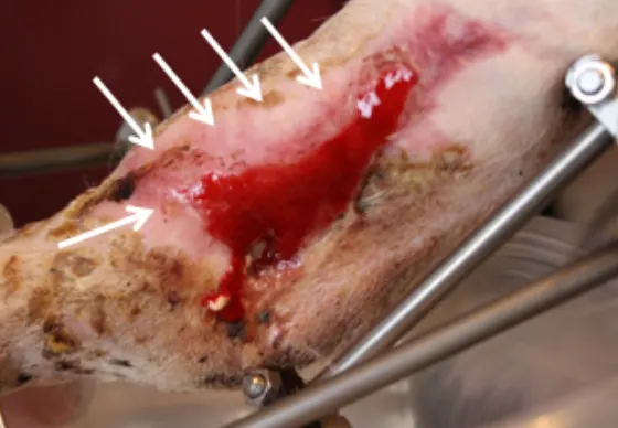 managing-degloving-shearing-injuries-step-by-step-guide