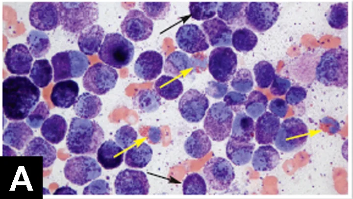 Stained cytology slide with arrows pointing to numerous eosinophils and mast cells.