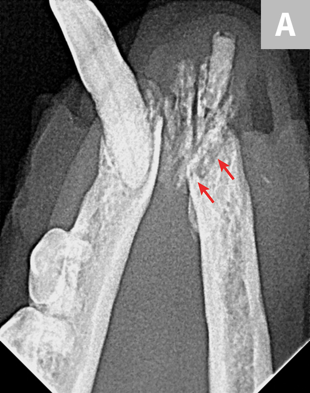 Top 5 Complications of Tooth Extractions Clinician's Brief
