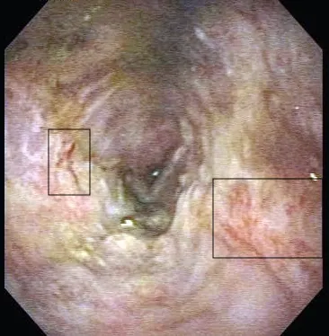 Endoscopic image of the patient’s esophagus.