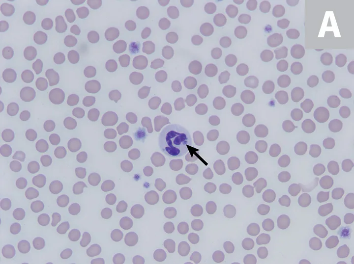 1A: Single neutrophil with arrow pointing to a small round purple-staining object within the cytoplasm. 1B: Three neutrophils, one with arrow pointing to a small round purple-staining object within the cytoplasm.