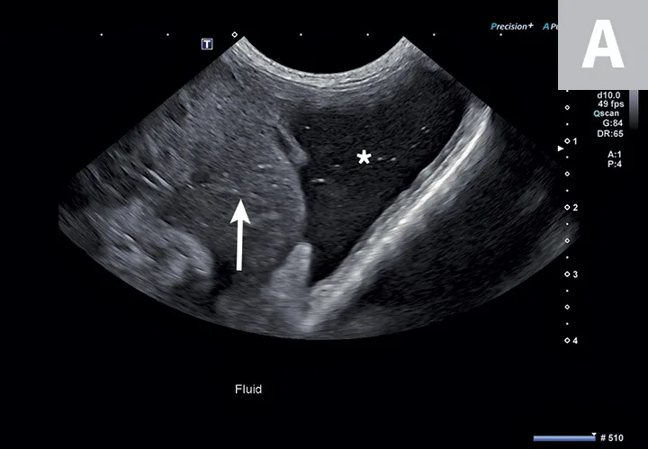 Two ultrasound images showing hypoechoic fluid adjacent to the spleen and to the heart.