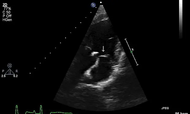 Ultrasound image of the left parasternal long-axis view of a dog’s heart showing a vegetative lesion on aortic valve.
