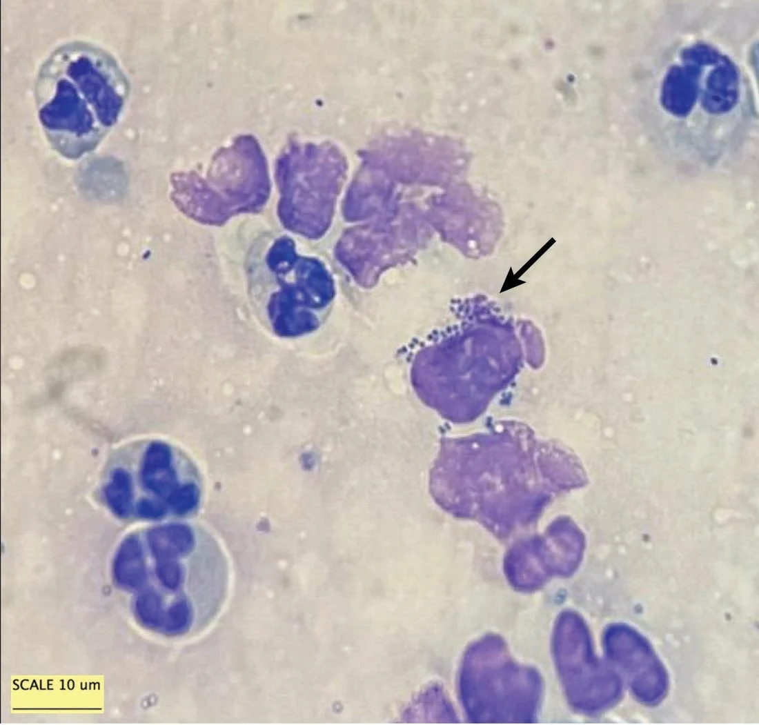 Two microscopic images of cytology obtained by sampling the eyelid margins.