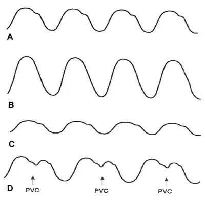 Four sets of arterial blood pressure waveforms, labeled A through D.