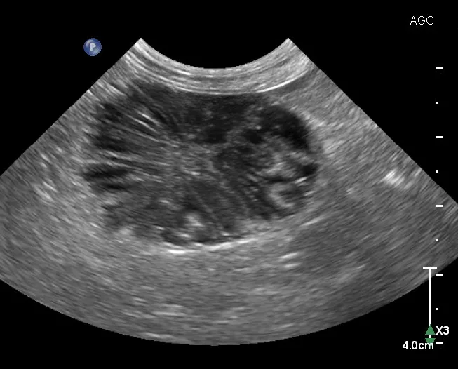 Ultrasound image of gallbladder of a dog with a hypoechoic mass containing hyperechoic radial striations.