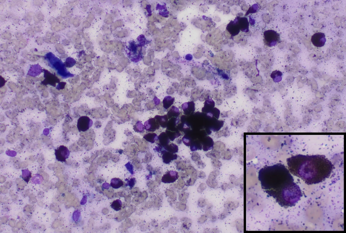 Single and clumped round cells containing black pigment that obscures nuclei in many of the cells.