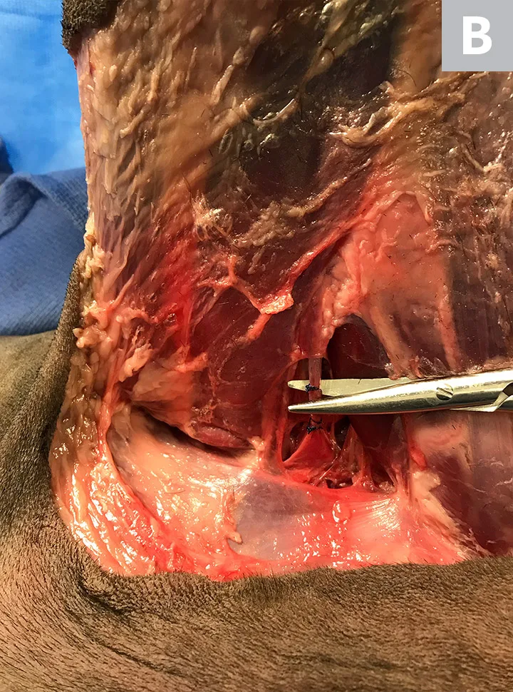 Two images showing femoral vein before and after ligation and where to cut between ligatures.