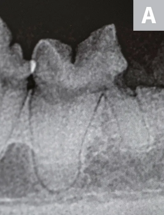 Three radiographic images demonstrating the features of Type 1, 2, and 3 tooth resorption.