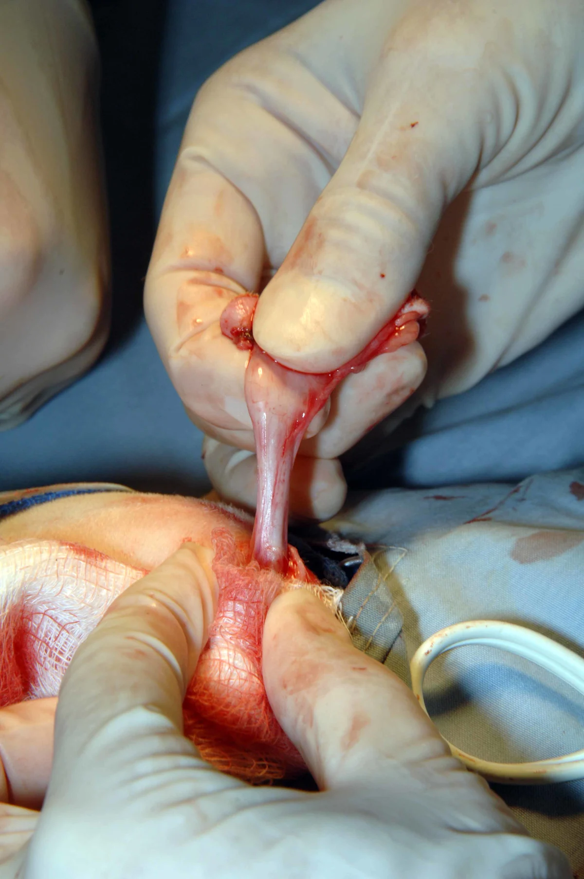 A: Intraoperative photograph of a surgeon using Metzenbaum scissors to dissect subcutaneous tissue from the penile body. B: Intraoperative photograph of a surgeon using gauze to strip subcutaneous tissue from the penile body.
